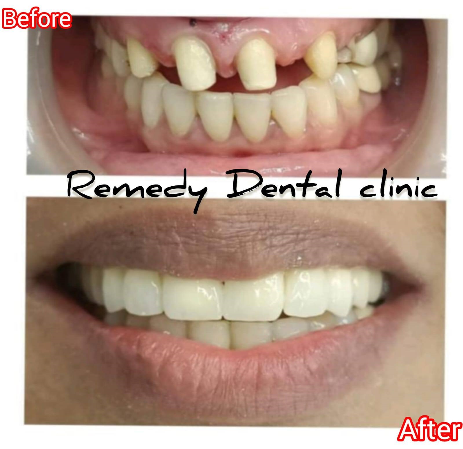Dental treatment before and after result - smile transformation case 1