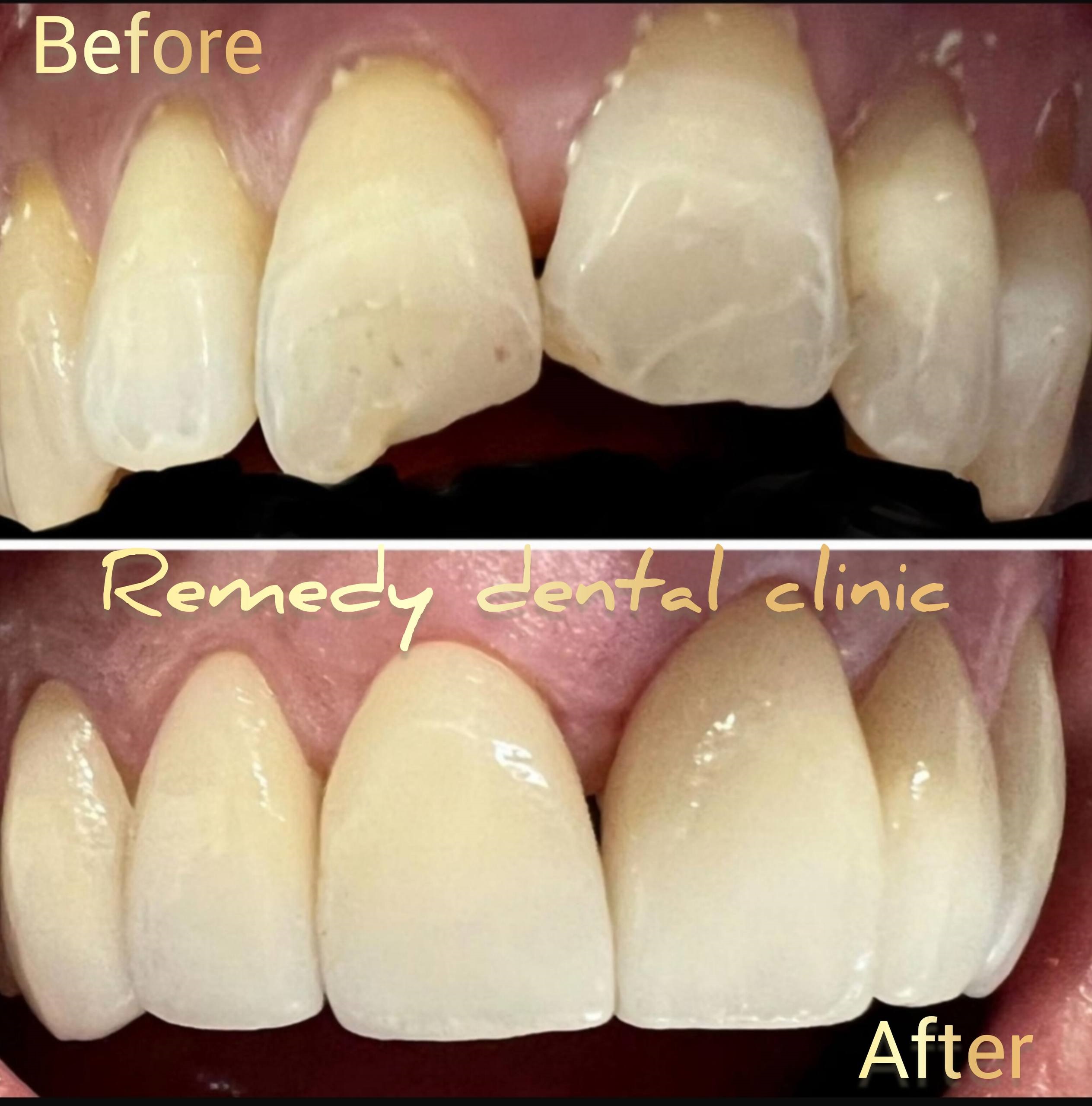 Complete smile makeover before and after at Remedy Dental Clinic