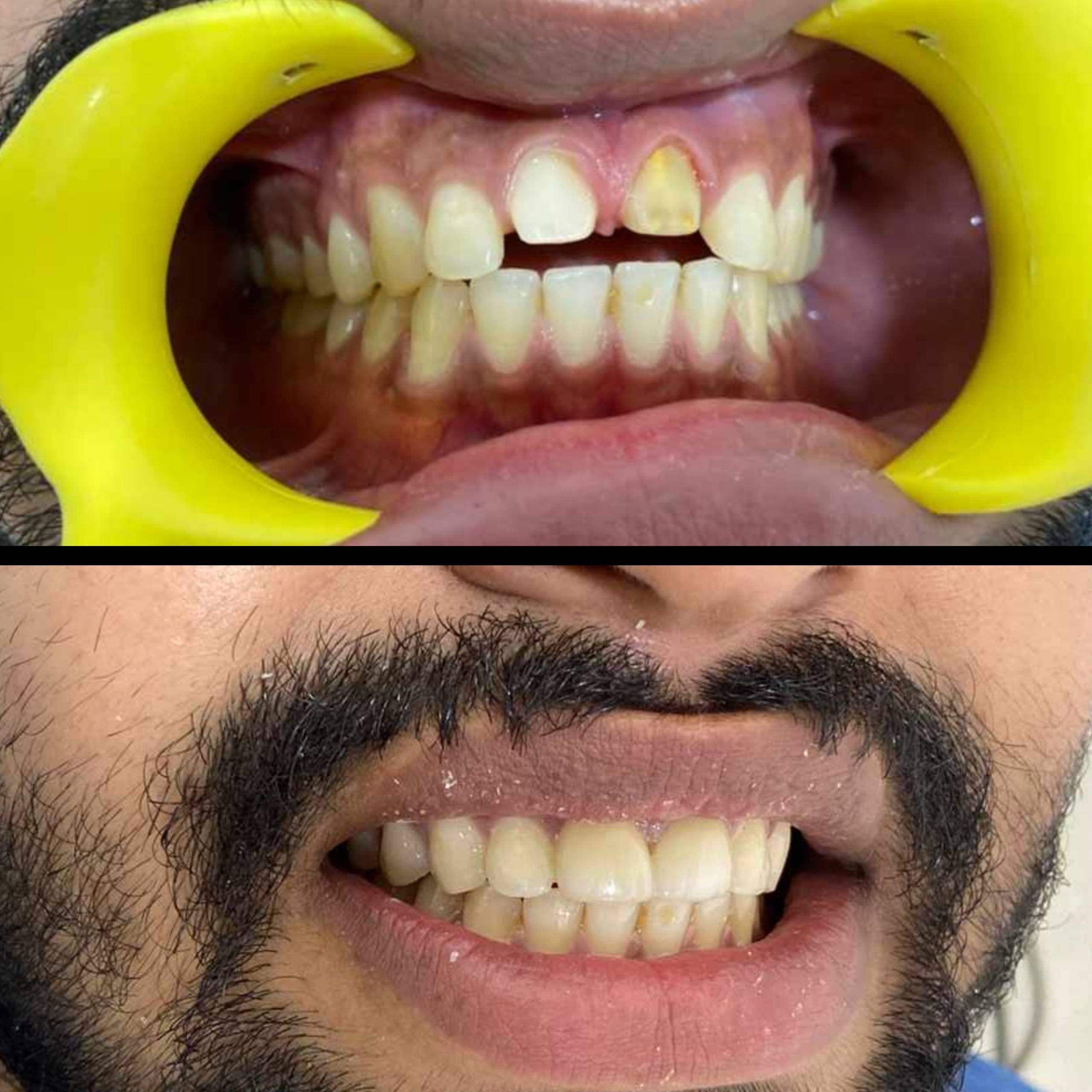 Dental care before and after results - patient transformation case 11