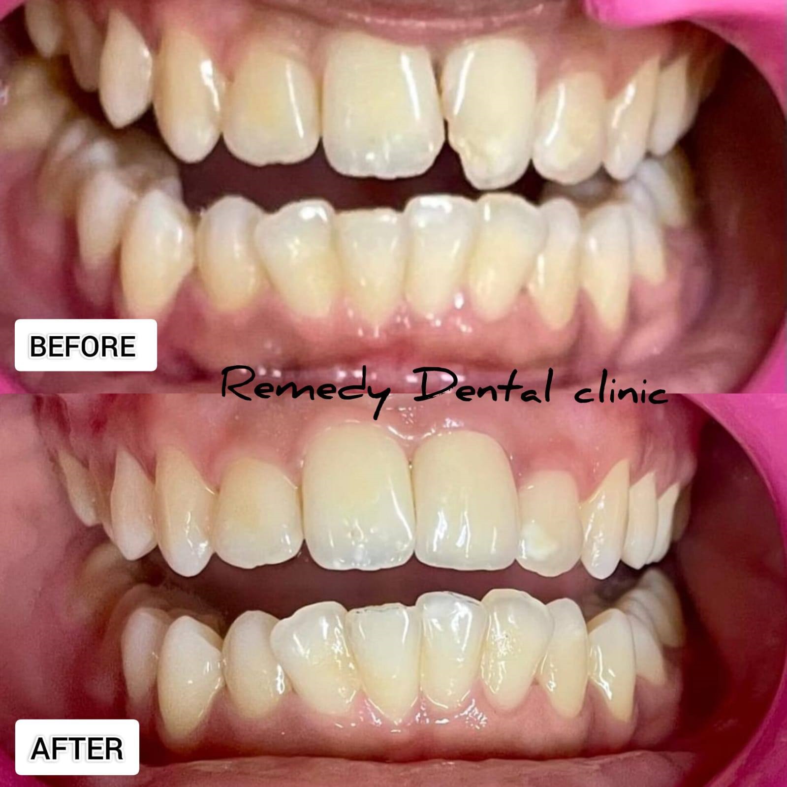 Teeth whitening before and after result at Remedy Dental Clinic