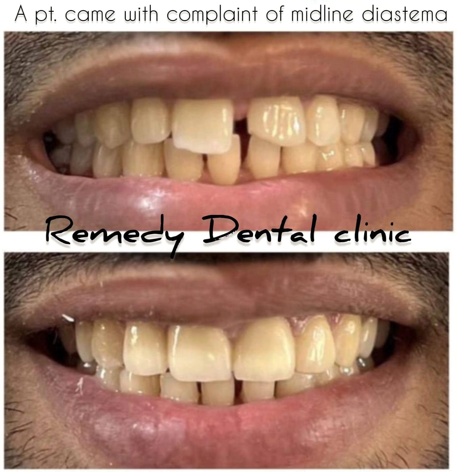 Dental restoration before and after - cosmetic dentistry case 3