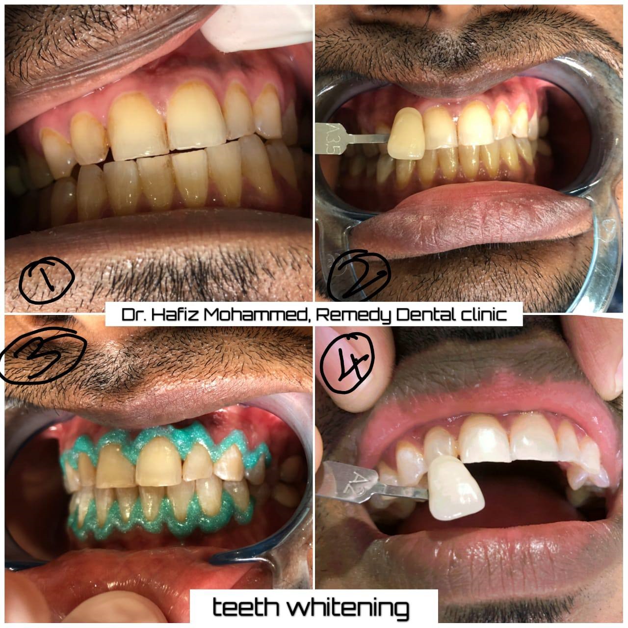 Smile makeover before and after result - dental transformation case 4