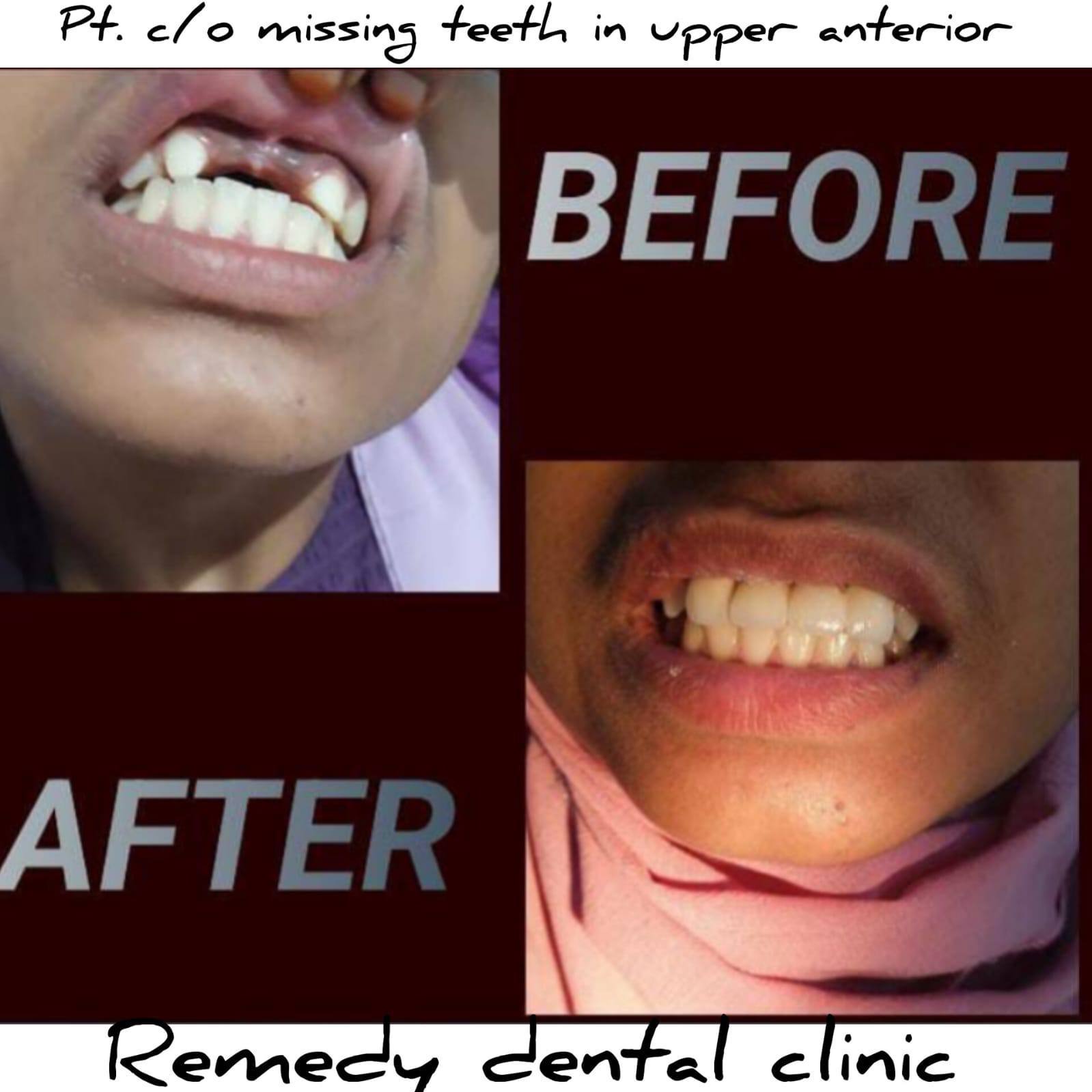 Dental implant before and after result showing natural-looking restoration
