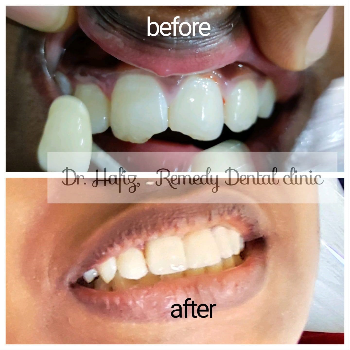 Orthodontic treatment before and after - teeth alignment result